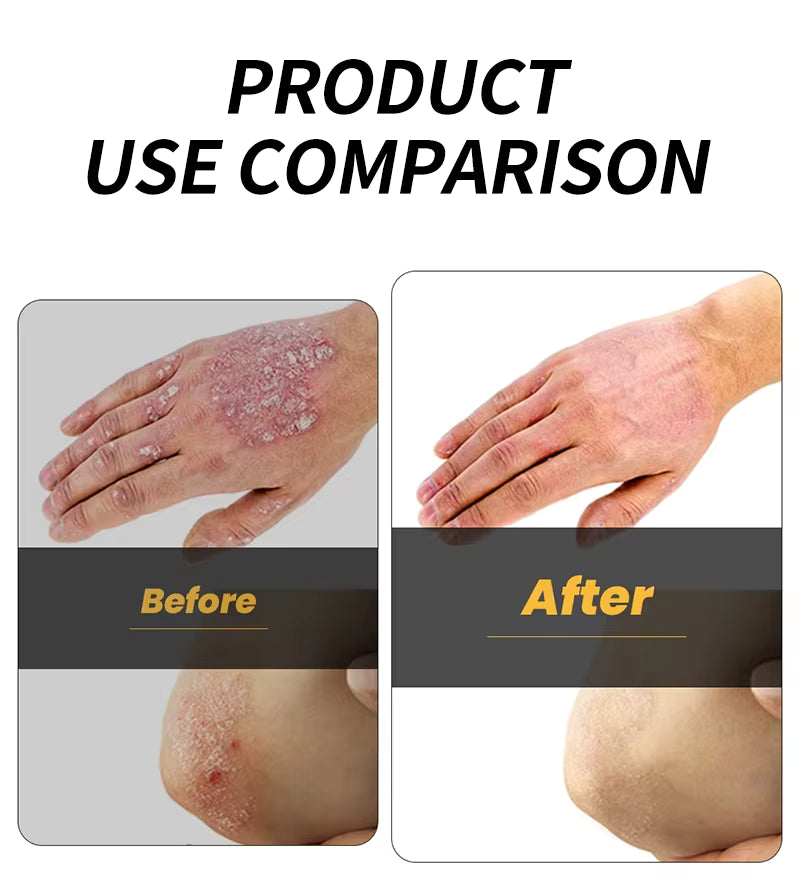 كريم التايغر الاصلي لازالة اللأكزيما والصدفية