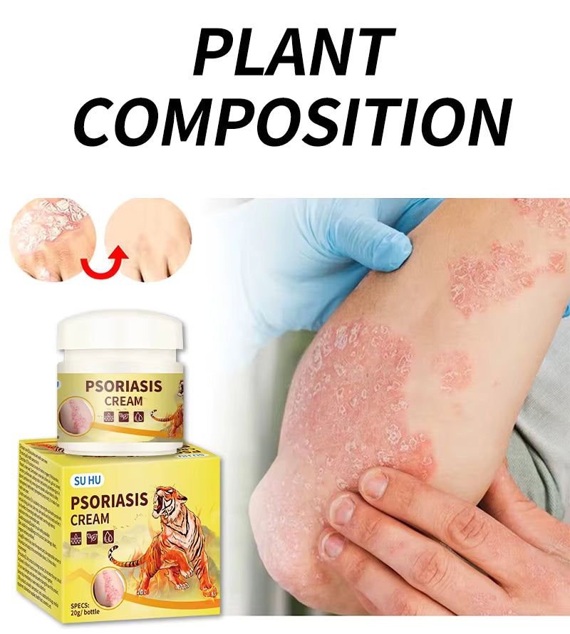 كريم التايغر الاصلي لازالة اللأكزيما والصدفية