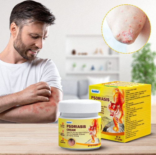 كريم التايغر الاصلي لازالة اللأكزيما والصدفية